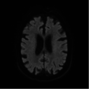 icd 10 code for left lacunar infarct